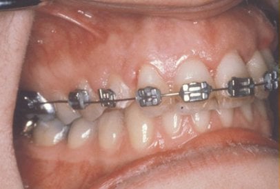 Successful Bite Correction for Canine Teeth