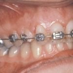 Successful Bite Correction for Canine Teeth